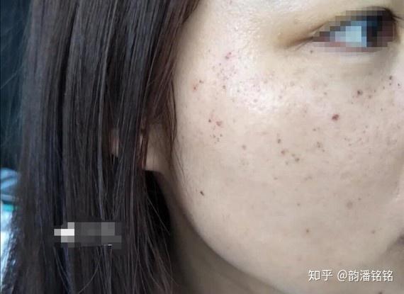 皮秒后反黑处理如何应对康康皮秒后如何护肤