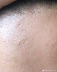 请问一下吃异维a酸后长出来的痘痘要特别处理吗?