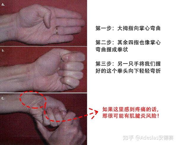1. 三秒钟判断是否患有腱鞘炎