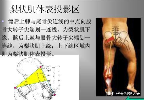 梨状肌综合症都有什么症状 知乎