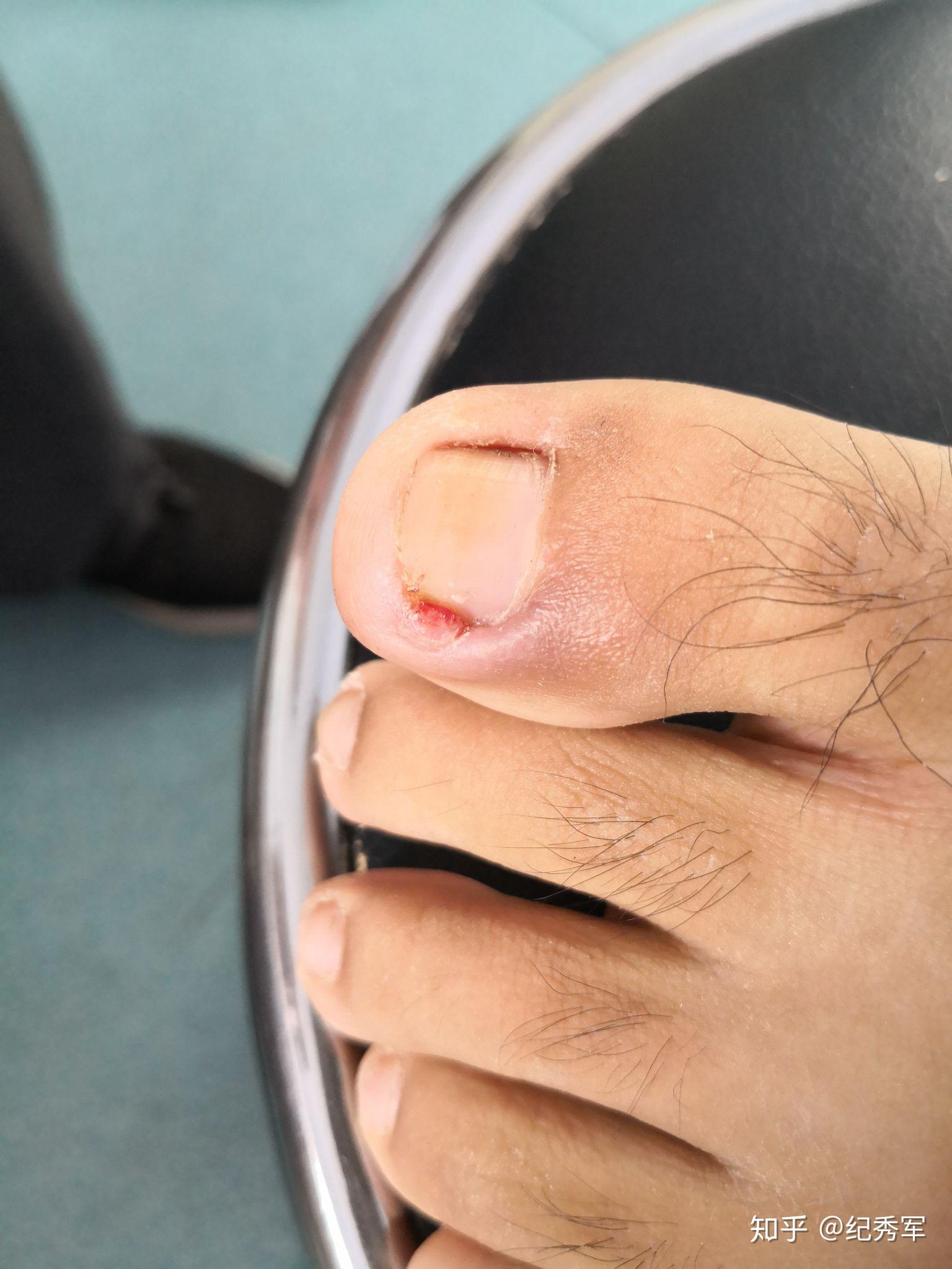 甲沟炎嵌甲大部分是自己剪指甲不当引起的