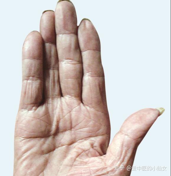 中医手诊如何诊断手掌小指 知乎