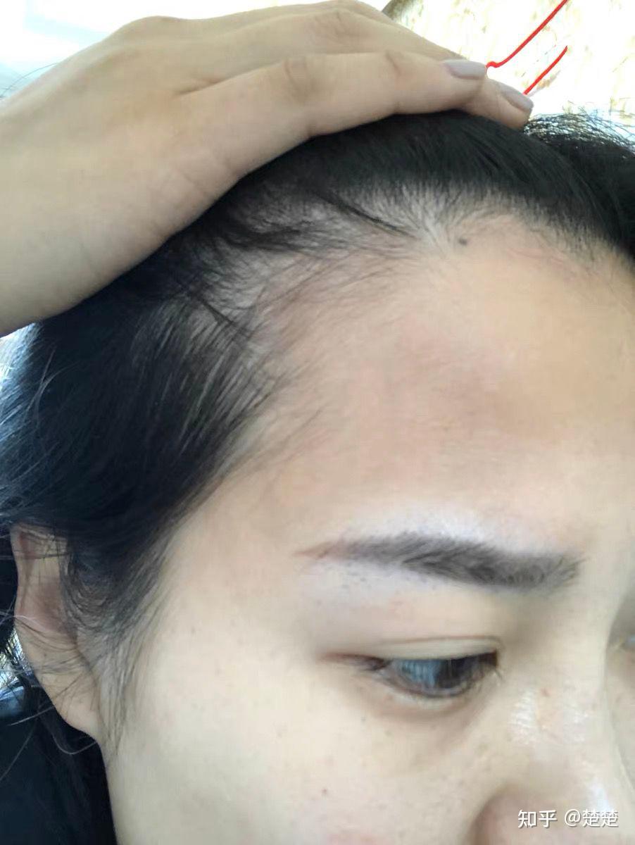 掉发严重,发鬓白花花的姐妹,快来看! - 知乎