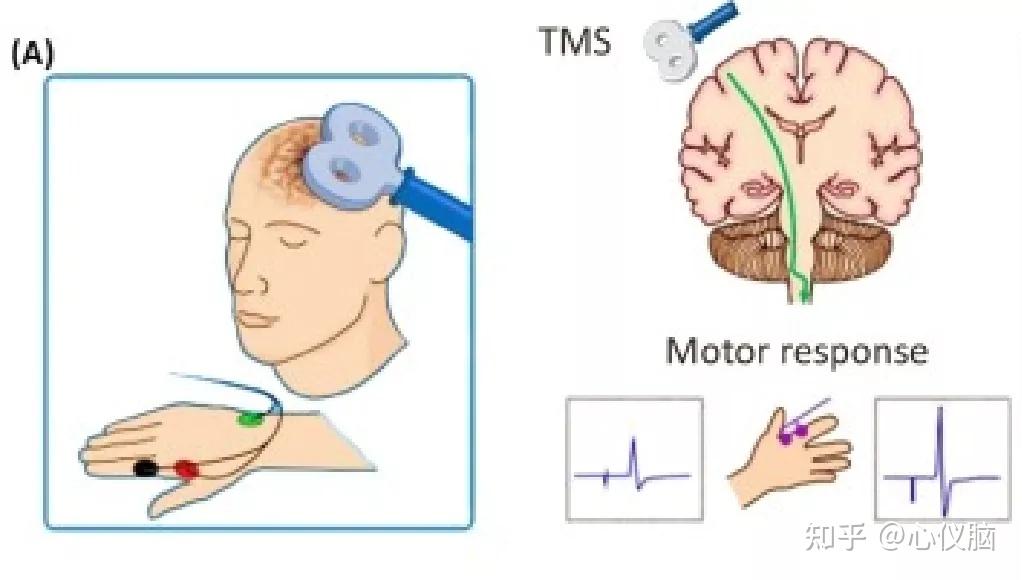 经颅磁刺激常用定位方法 知乎