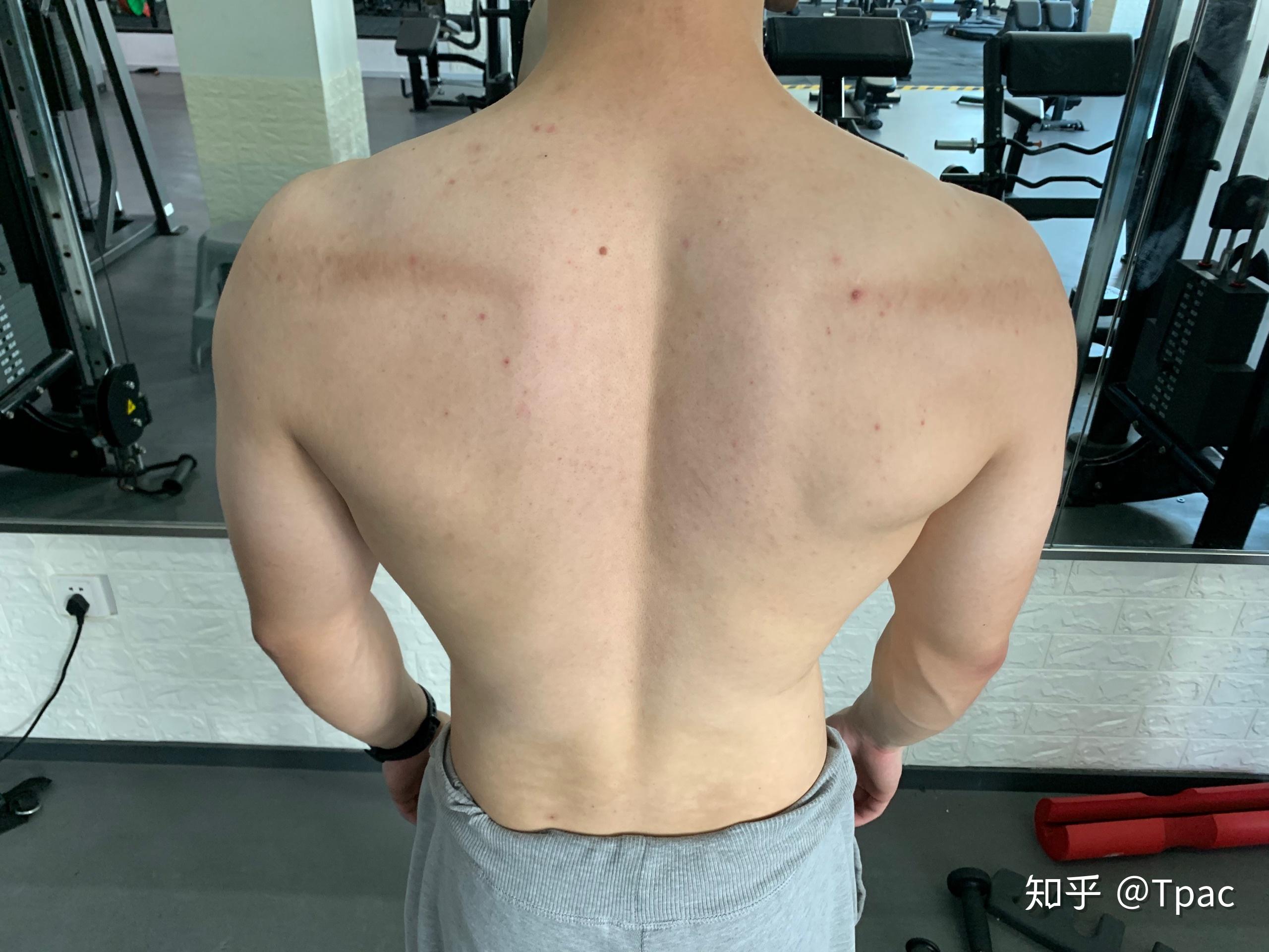 低杠深蹲,后背擦伤了,正常吗?