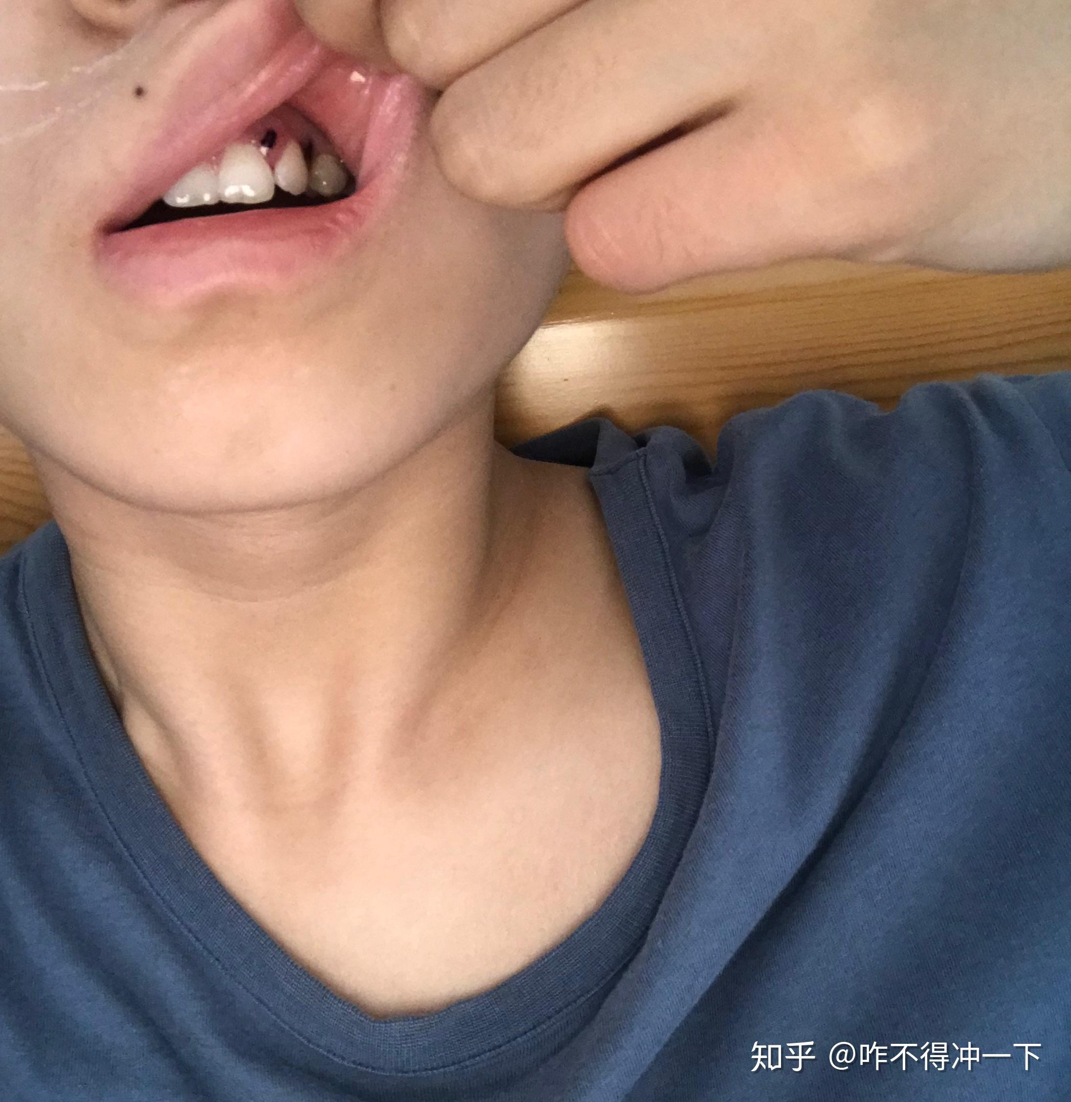 乳牙滞留拔水平埋伏牙有感07▽