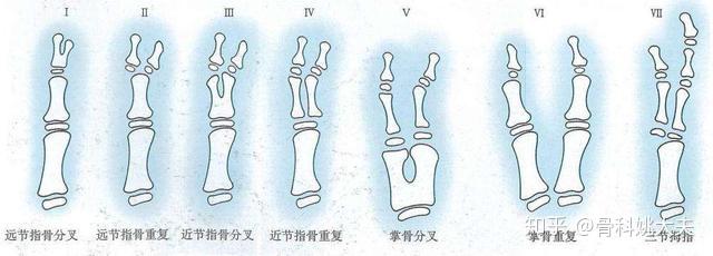 儿童骨科医生需要根据孩子的关节骨骼生长发育程度,稳定性,活动情况等