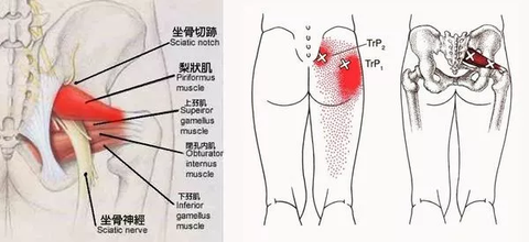 坐骨神经痛 到底是梨状肌综合征还是腰椎间盘突出 知乎