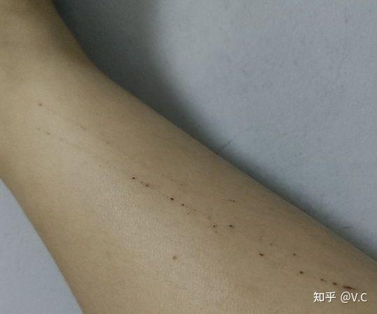 破片出血の見通し