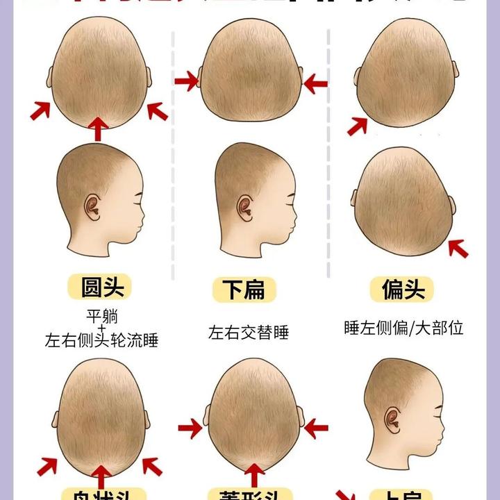 【宝宝头型】教你如何睡出小圆头！|||️常见正常问题头型特征 - 知乎