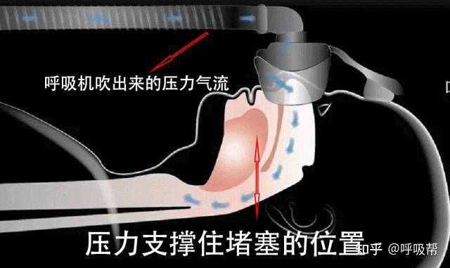 睡眠呼吸机选购指南：浅谈CPAP和APAP那个更适合打鼾 - 知乎