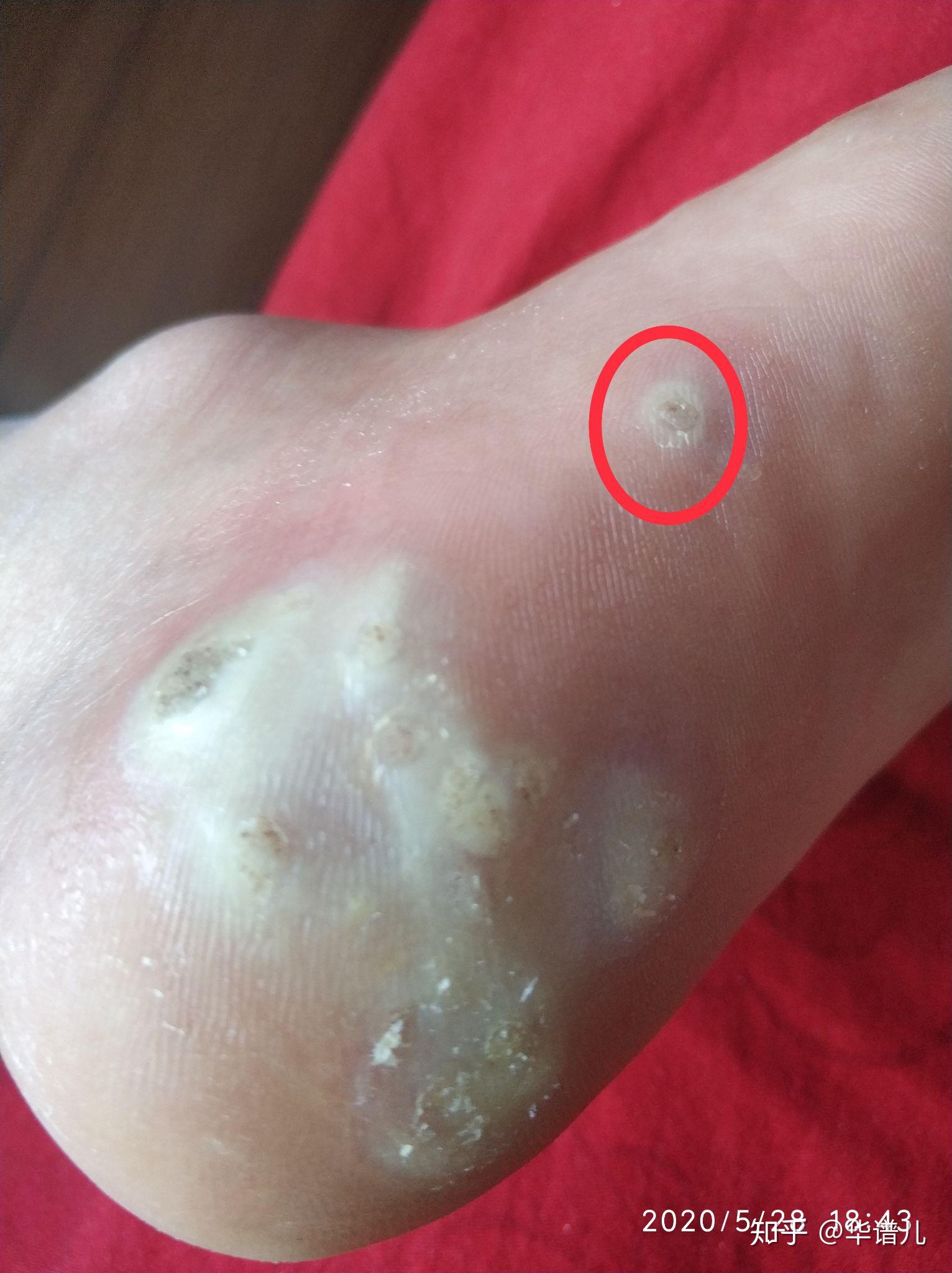 几毛钱的东西轻松治跖疣
