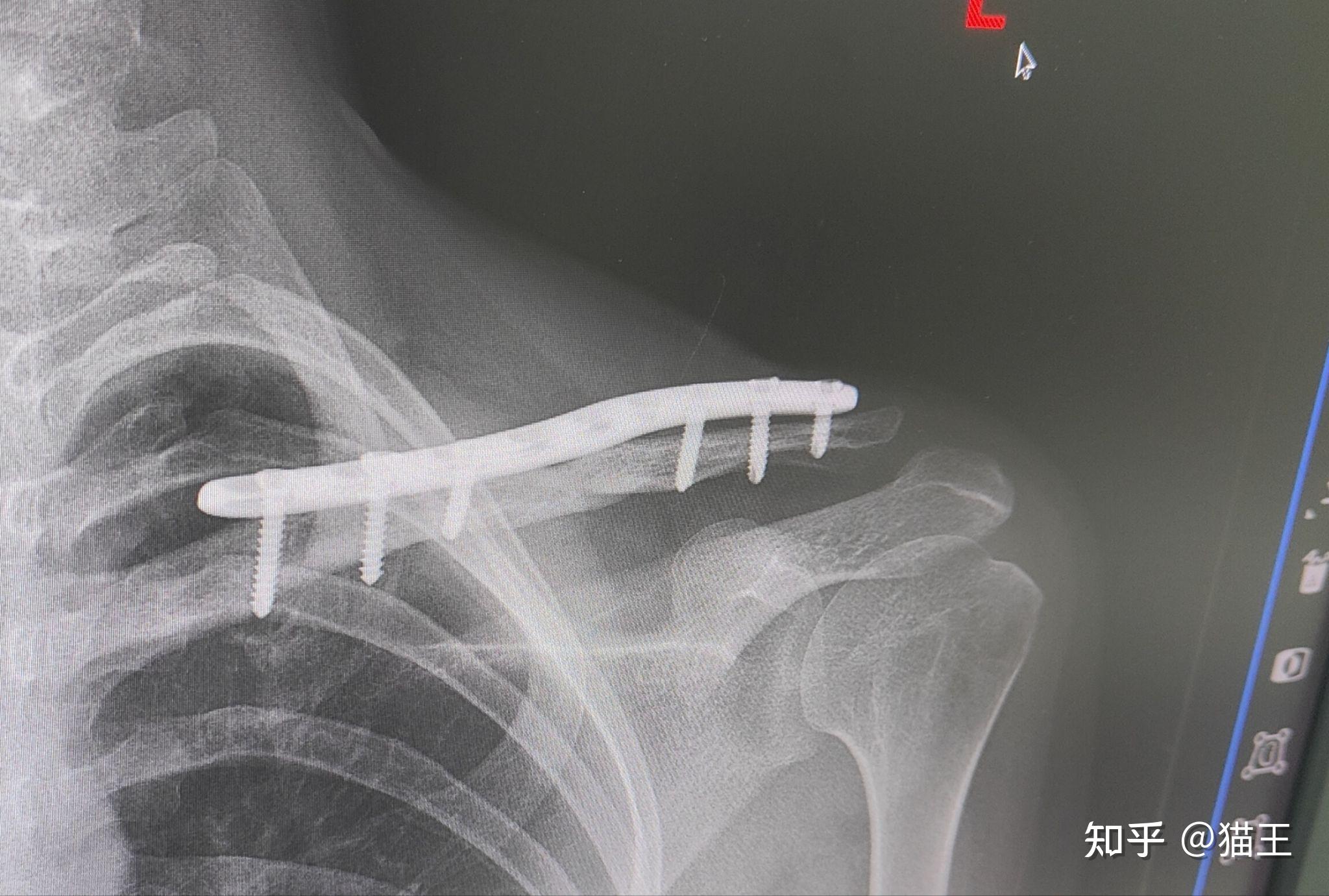 右锁骨骨折(allman 2型)；右肩锁关节脱位（？）