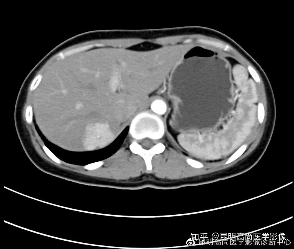 昆明高尚医学影像诊断中心【病例】上腹部ct肝脏局灶性结节增生!