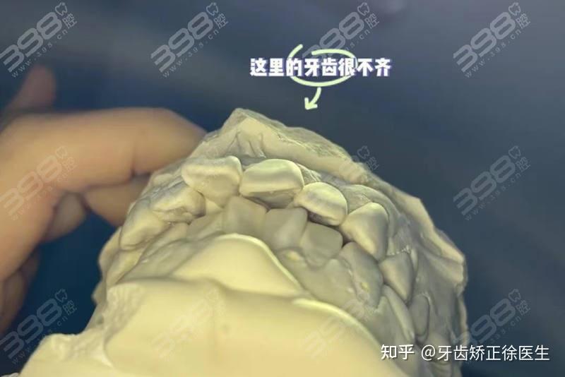 网上流传着门牙外凸不建议再矫正了 竟有人认为牙齿有点外凸能自己按进去吗 - 知乎