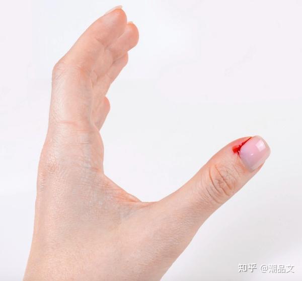 《科普》手指边缘长倒刺、脱皮不是因为干燥,竟和营养不良有关? - 知乎