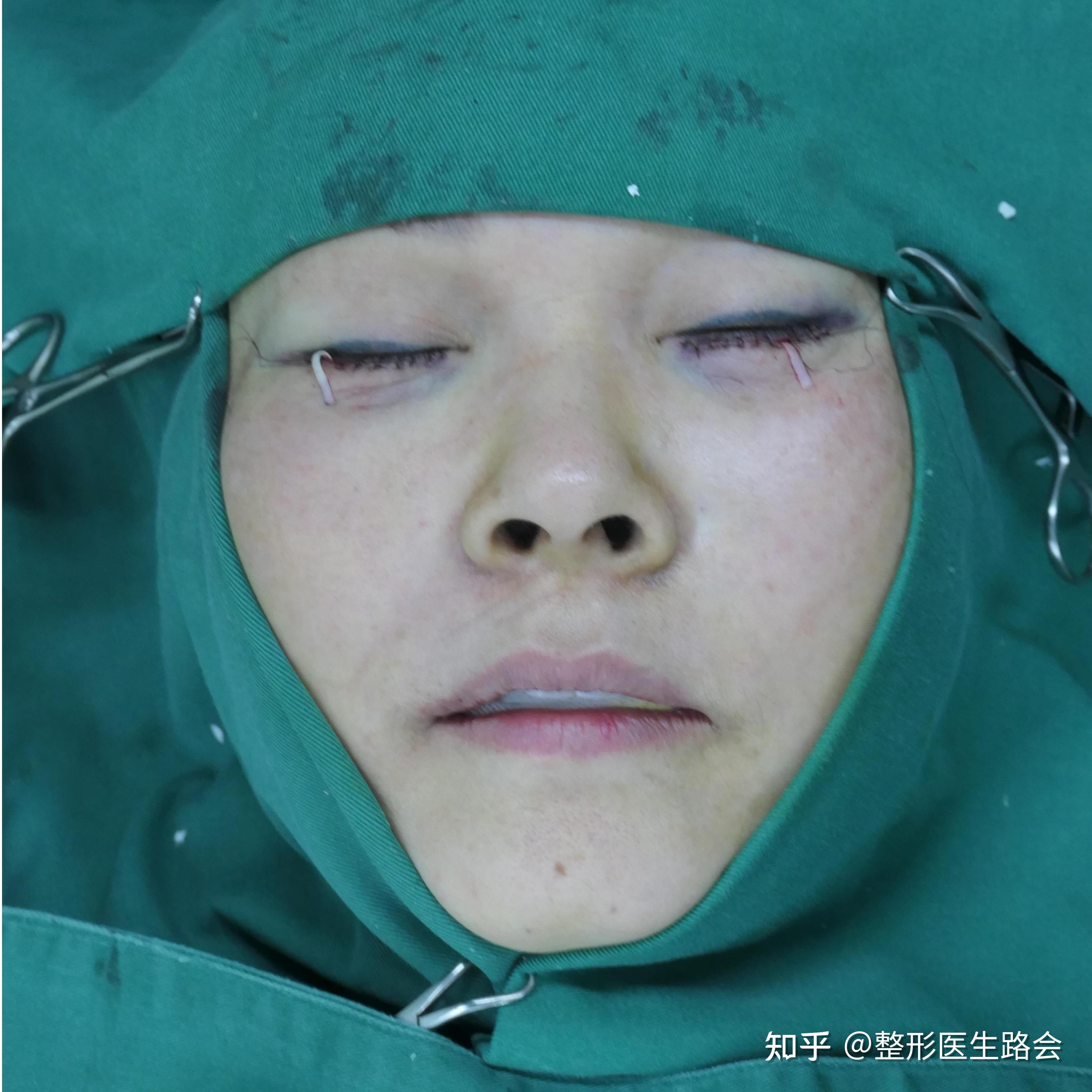 贵州贵阳双眼皮年轻化手术+外切眼袋眶隔脂肪释放填泪沟手术 - 知乎
