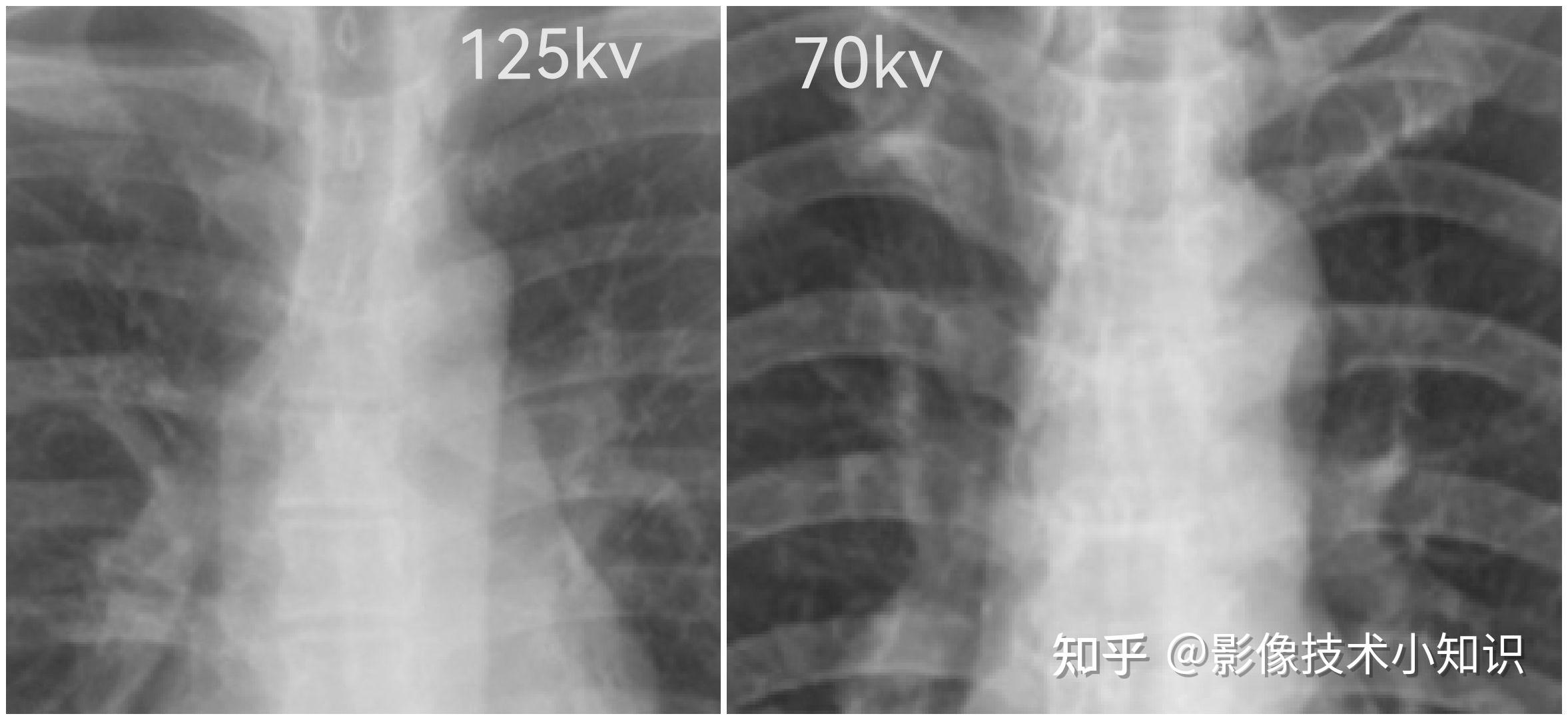 DR图像质量控制(1) - 知乎