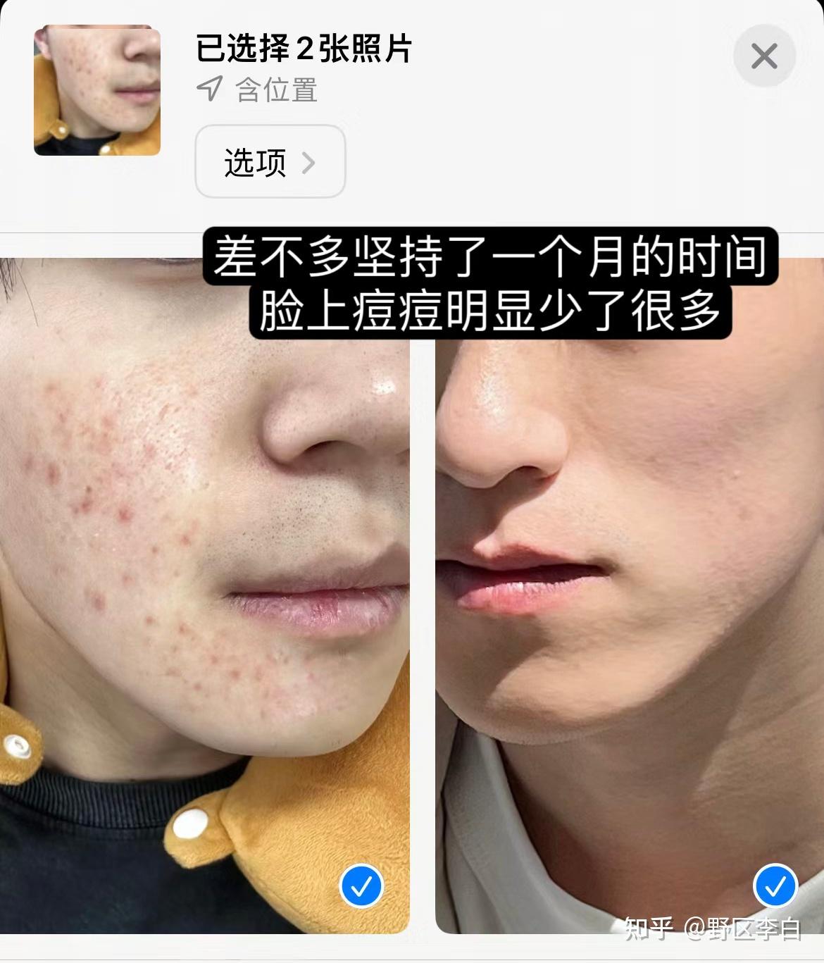 在所有的面部问题中,颜值杀手非痘痘莫属!