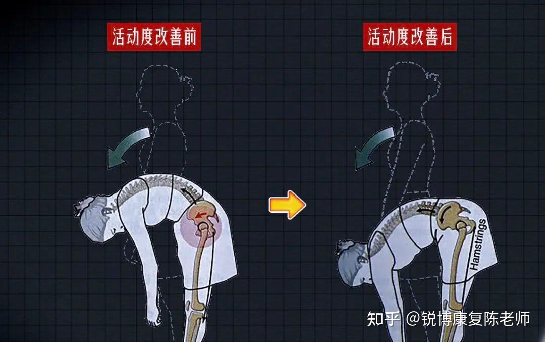 【锐博康复科普】【腰突腰痛康复】腰椎曲度变直/反弓别慌!还有救! - 知乎