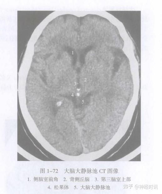 大脑大静脉池磁共振图片