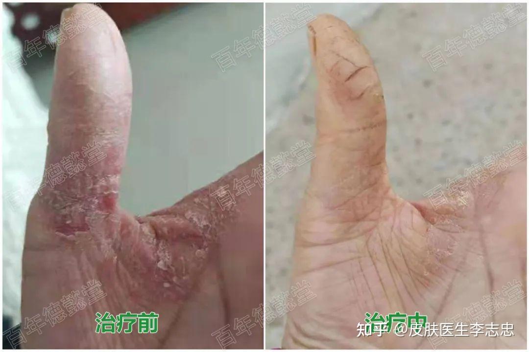 德懿堂治疗掌跖脓疱病医案一则