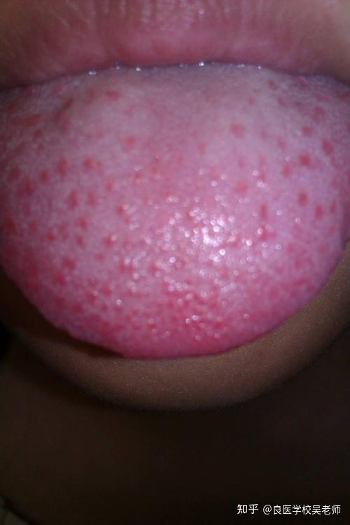 色谈,凹陷性的草莓舌,多见于慢性病或虚症,比如胃阴虚的胃病等