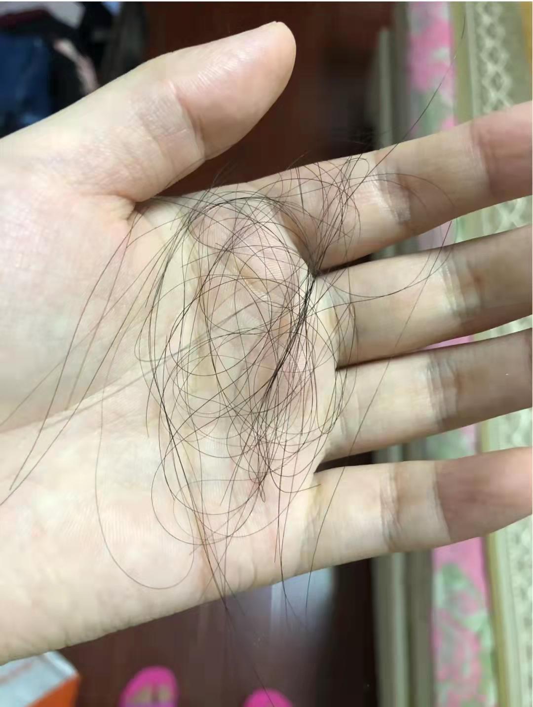 掉发脱发怎么办掉发越来越严重了怎么办