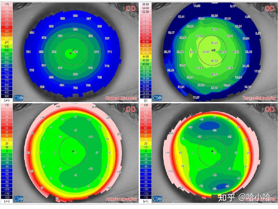 角膜地形图详解 - 知乎