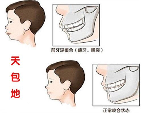 牙齒矯正真的會改變臉型嗎如何避免牙套臉