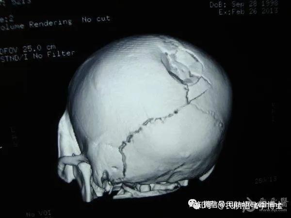 颅盖骨折图片