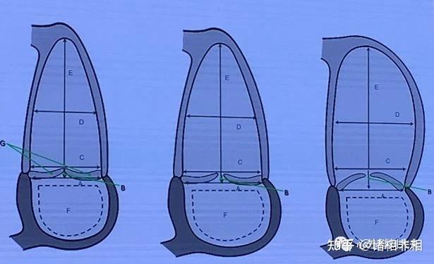 三尖瓣返流的臨床治療