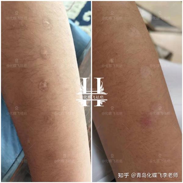 烟头烫伤疤痕成功上岸，体检通过😊 - 知乎