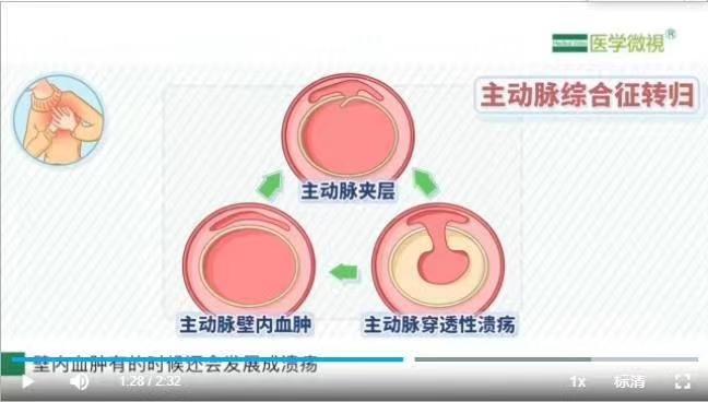 究竟"主动脉壁内血肿"与"主动脉夹层动脉瘤"是否属于同一种疾病,从