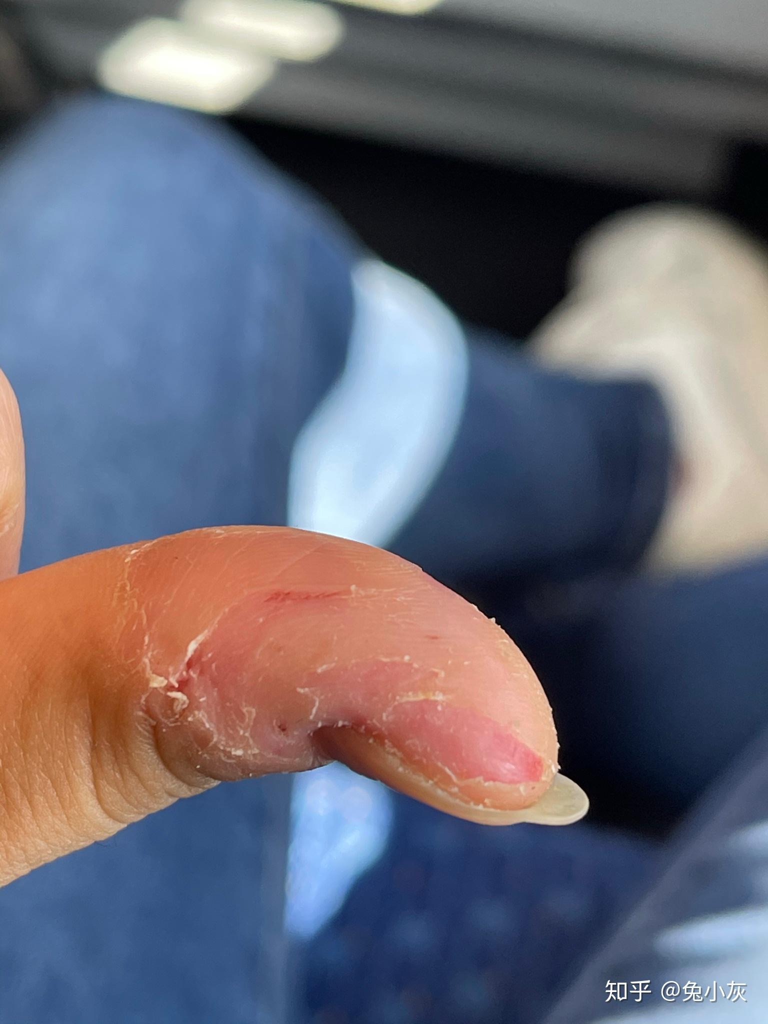 成年人如何改掉抠手的习惯?有什么心理学道理? - 知乎