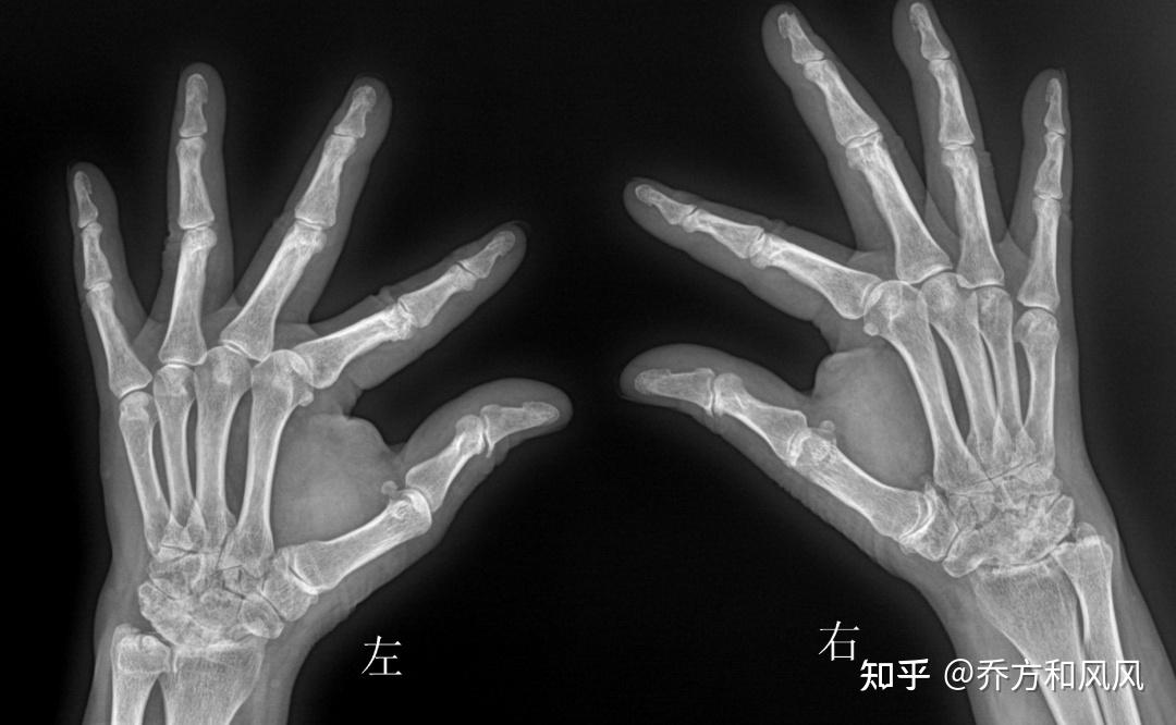 一文读懂诊断类风湿关节炎患者要做哪些检查