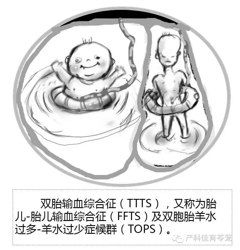 单绒毛膜性双胎还会发生一些特殊的并发症:发生并发症的风险高b超检查