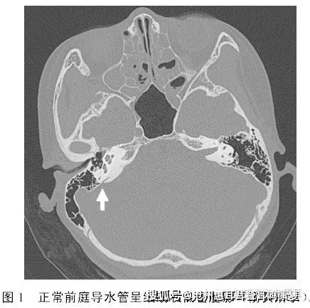 沧州惠耳教你读懂CT片——大前庭导水管综合征的CT影像学诊断 - 知乎