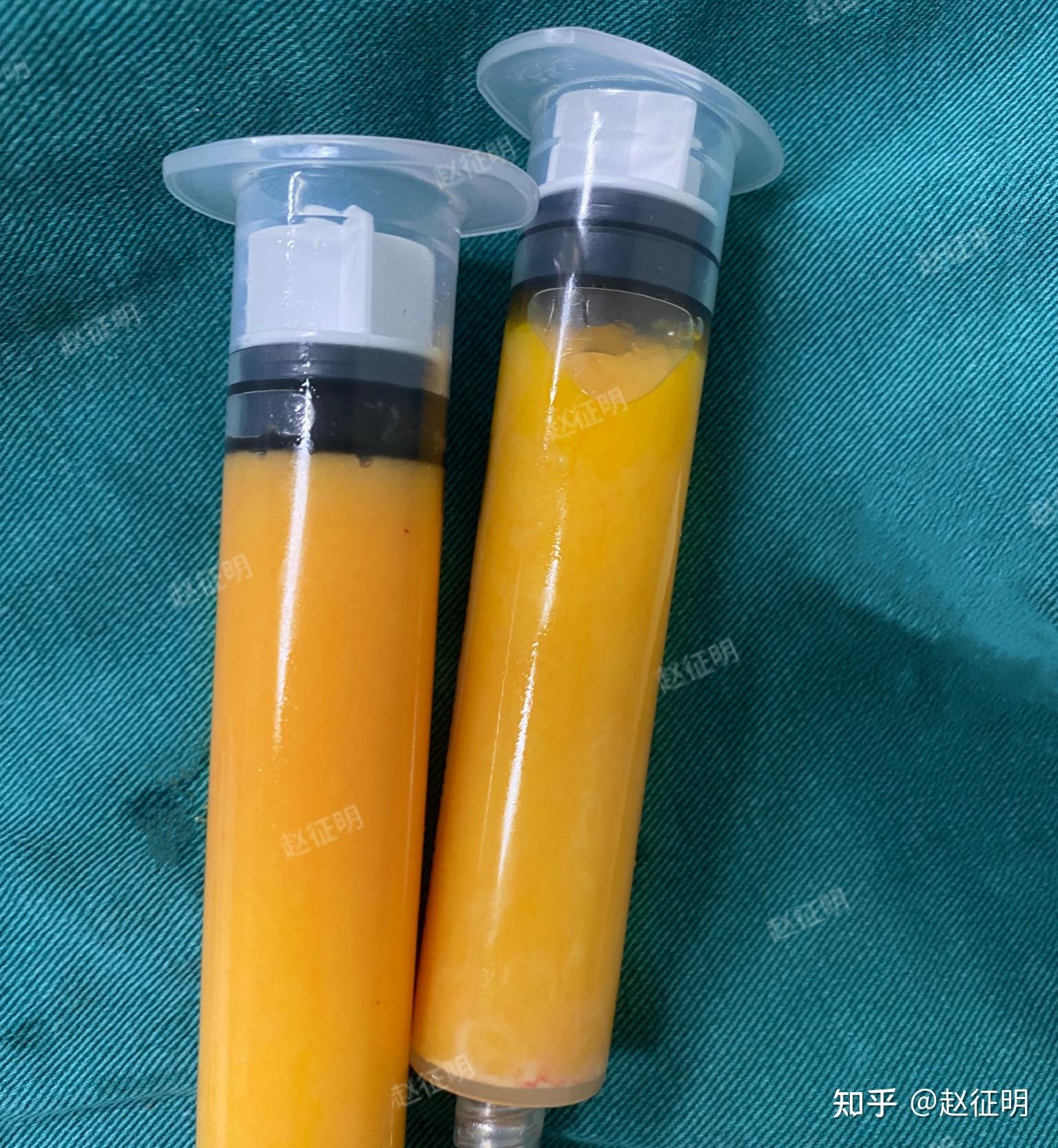 自体脂肪填充面部知多少