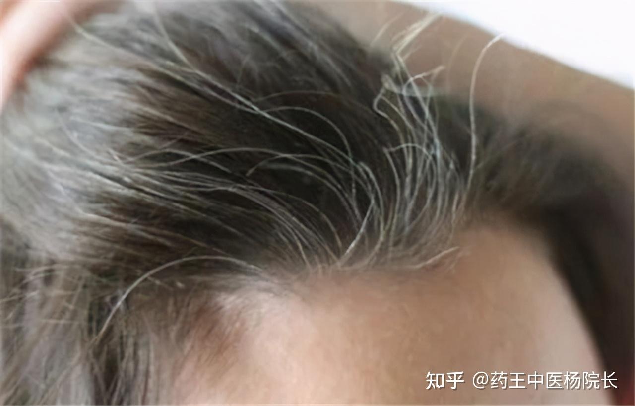 为什么白头发越长越多?不要以为自己老了,或是缺了这两种营养 - 知乎