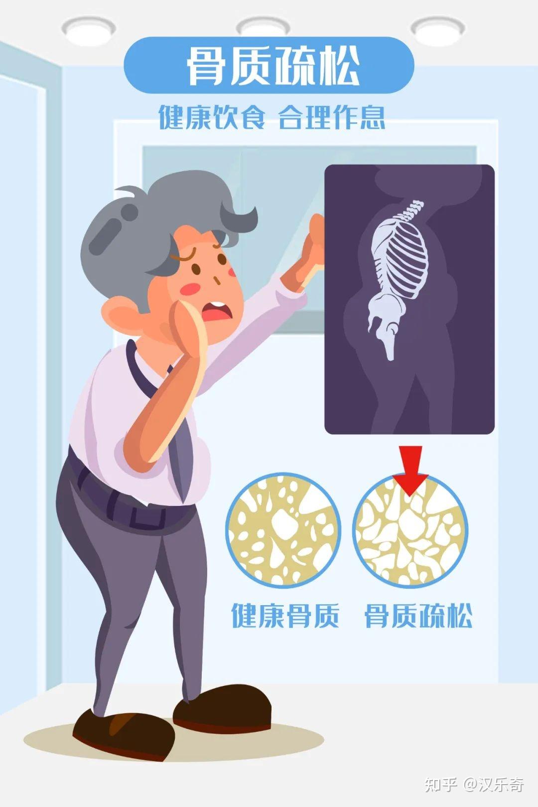 骨质疏松是"隐形杀手"