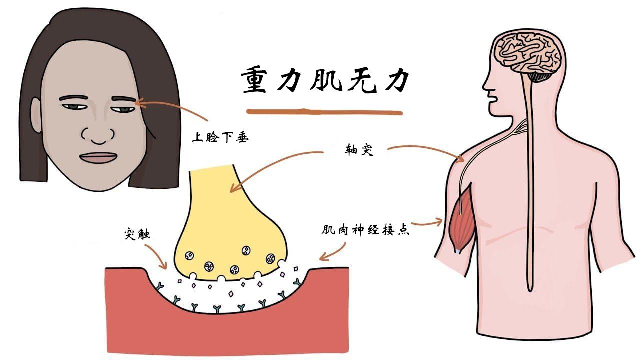 首個全身型重症肌無力長效c5補體抑制劑ultomirisravulizumabcwvz於