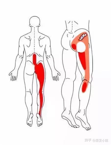 腰椎间盘突出症绝大多数病人发生在腰4