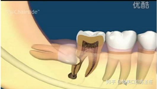 東莞拔智齒多少錢全方位科普智齒究竟該不該拔