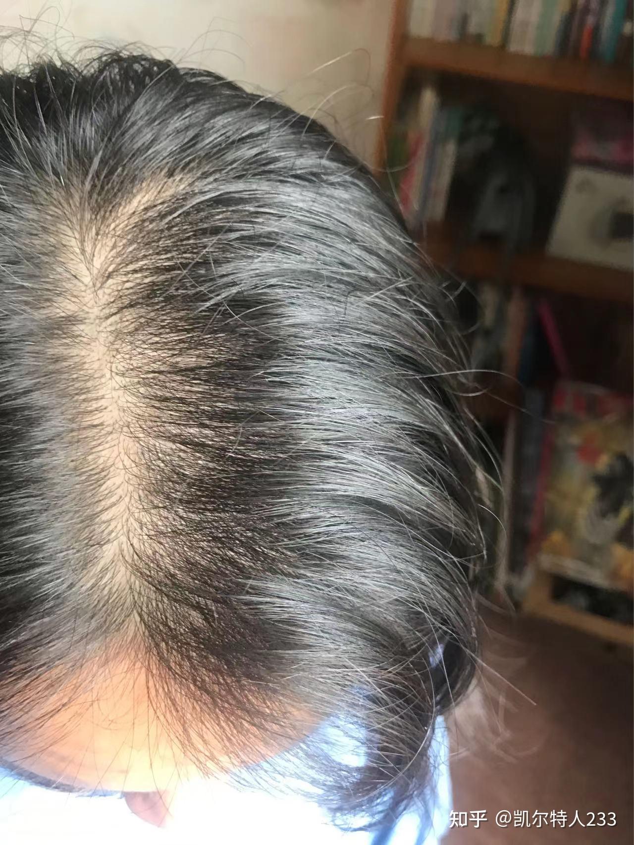 植发算医(植发算医美嘛)