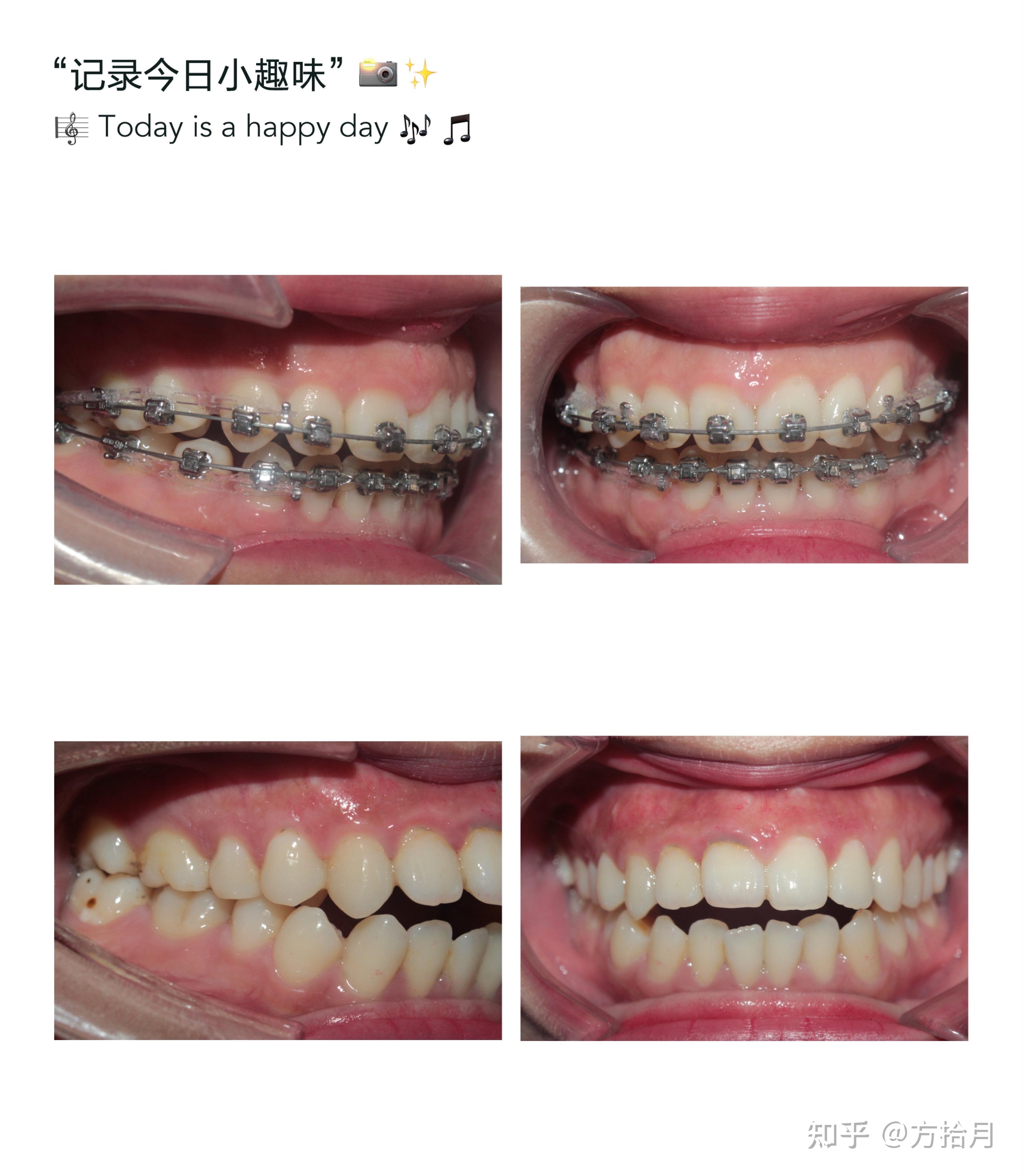 南京牙齿矫正推荐哪家医院骨性前后对比分享