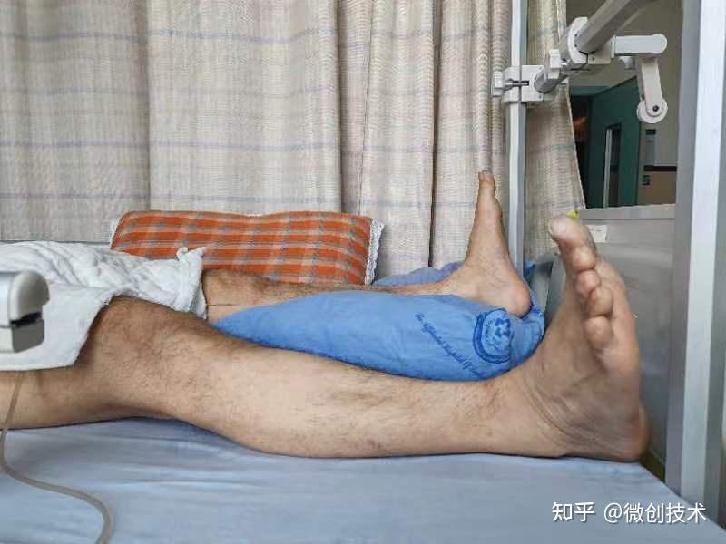 案例解析|西南医科大学附属医院c3型骨盆骨折微创手术