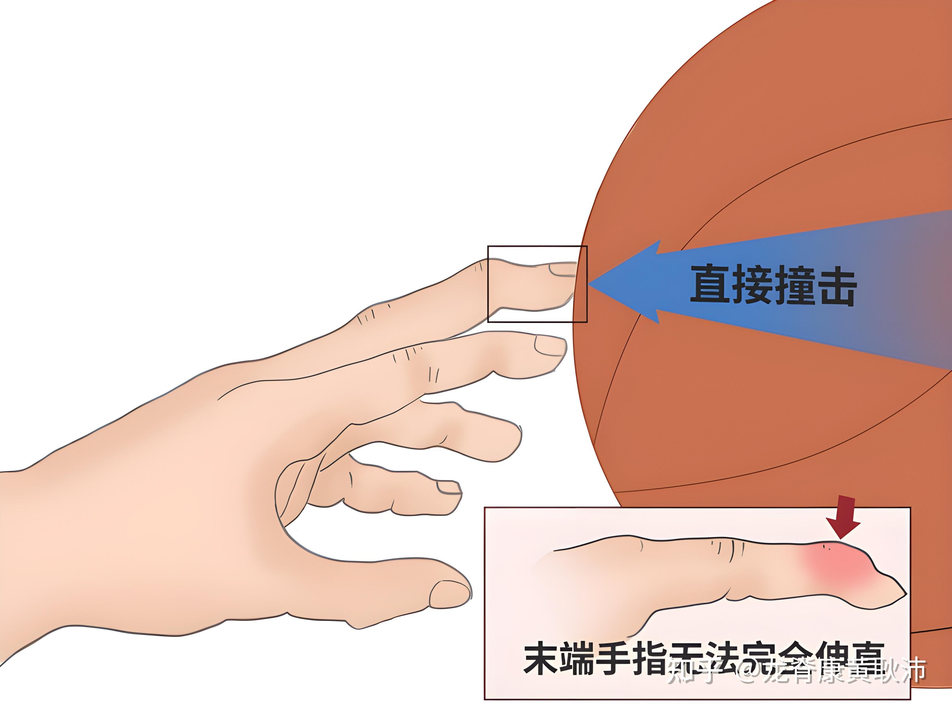 二十天前,在一次激烈的篮球比赛中不慎撞伤了左手尾指