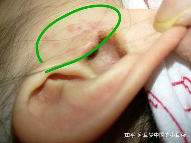 中耳炎的辨识 - 知乎