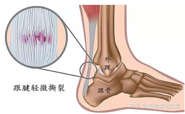 跟腱炎:是跟腱在急性或者慢性劳损后形成的跟腱部位的一种退行性变化